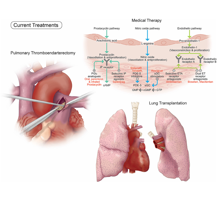 Chronic Thromboembolic Pulmonary Hypertension CTEPH