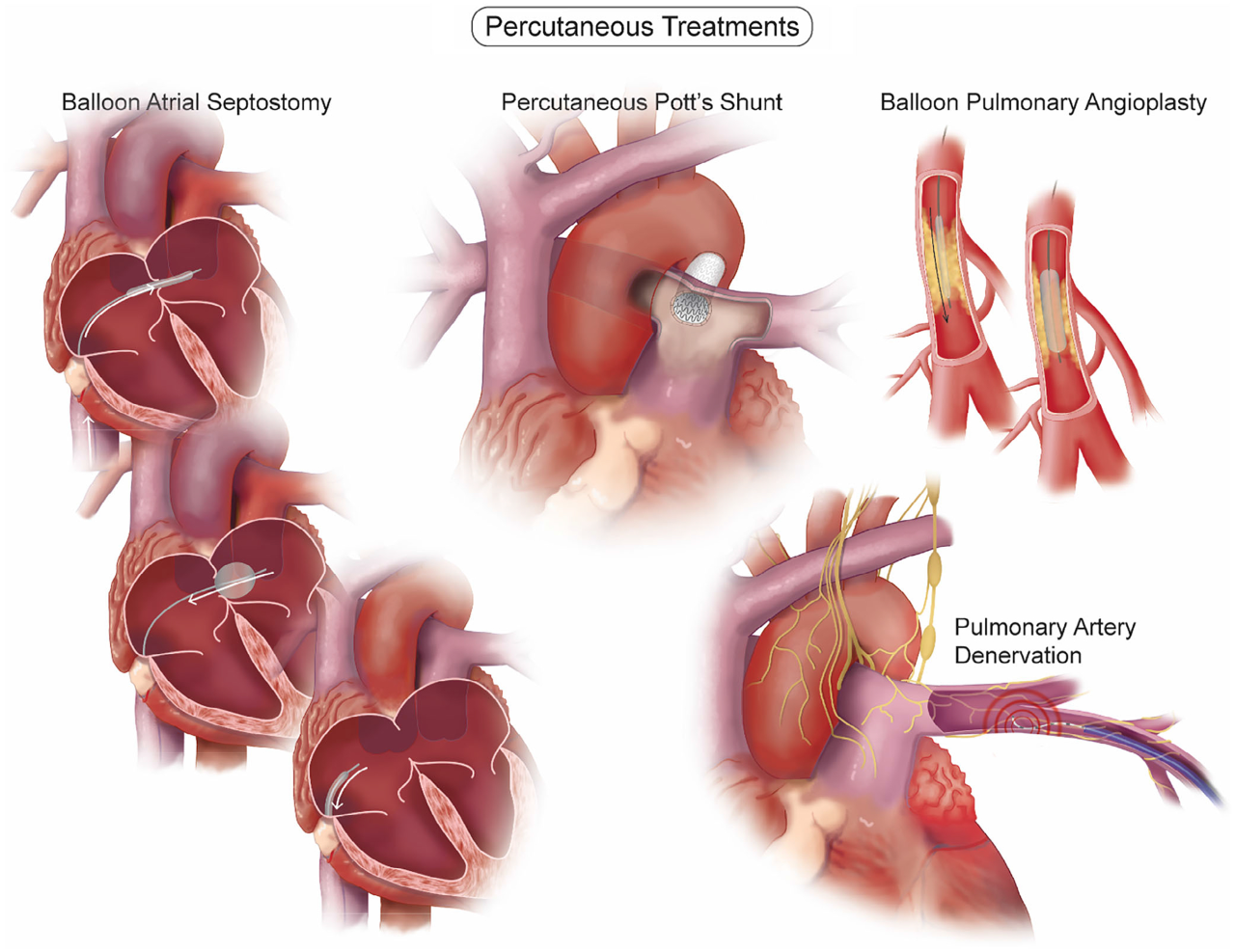 Chronic thromboembolic pulmonary hypertension CTEPH
